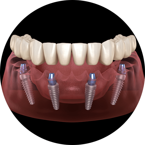 full-arch-dental-implants dental implants