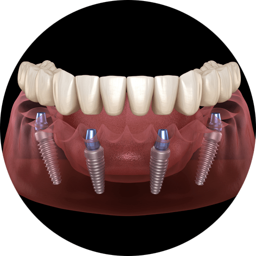 dental implants