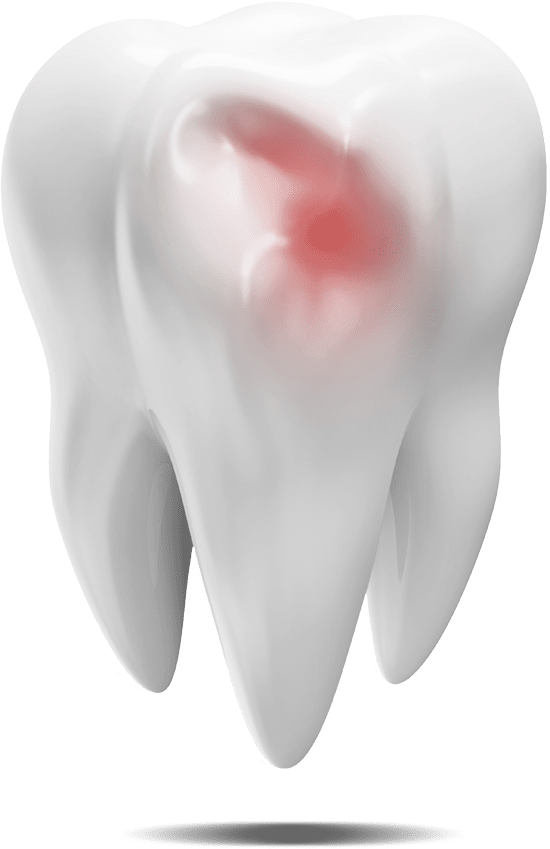 damaged-tooth-graphic damaged tooth graphic