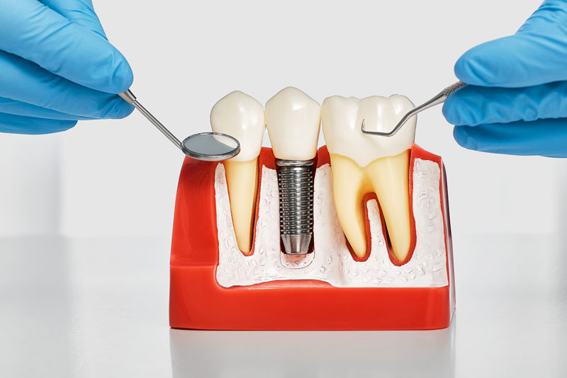 My Dental Company - Dental implant model bone cutaway showing Osseointegration