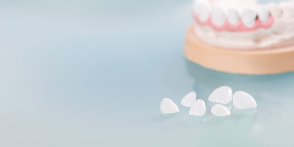 dental-veneers-model-1024x512 smile makeover