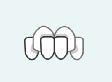 crossbite - invisalign fix Crossbite