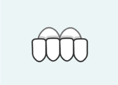 overbite-invisalign-fix Overbite