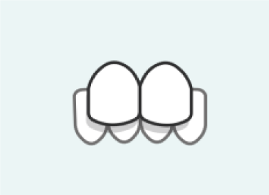 underbite-invisalign-fix Underbite