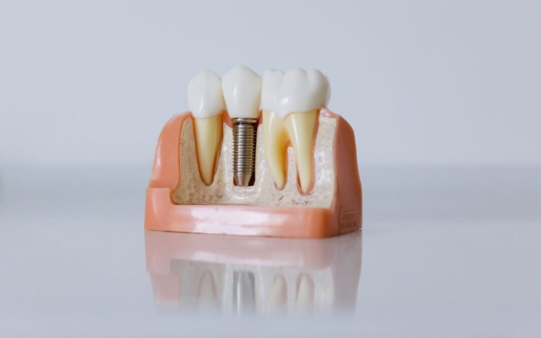How Much Do Dental Implants Cost in Colorado Springs? A 2026 Pricing and Financing Guide