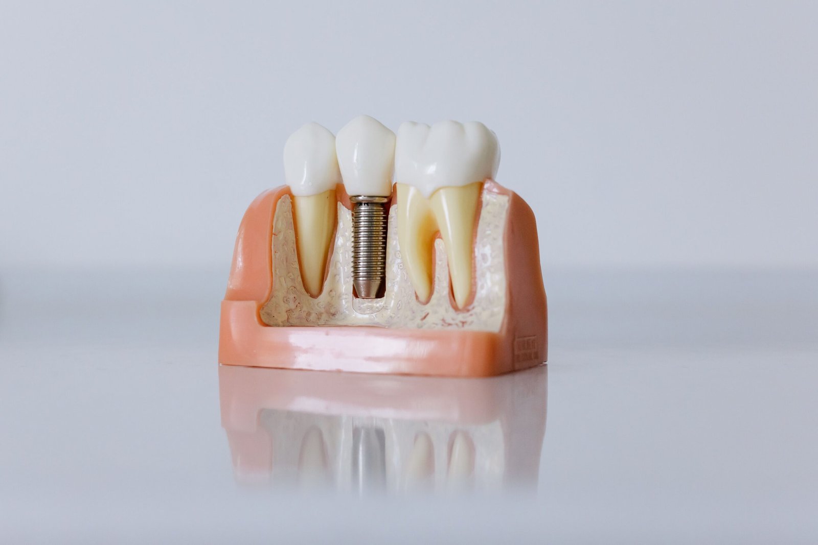 How Much Do Dental Implants Cost in Colorado Springs? A 2026 Pricing and Financing Guide